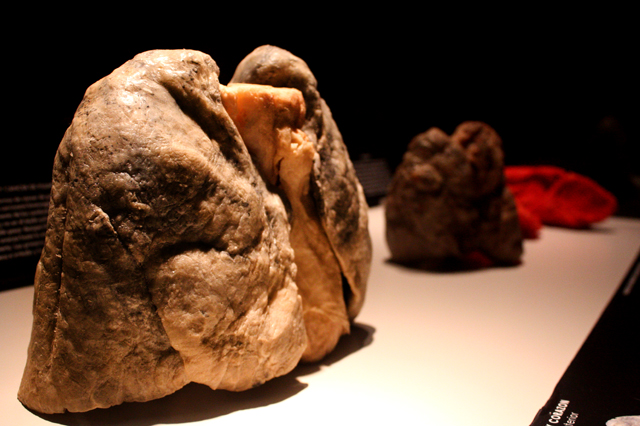 Los órganos que forman parte de la exhibición han sufrido enfermedades o traumas. En primer plano la vista anterior de los pulmones y corazón.